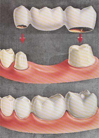 dental-bridge