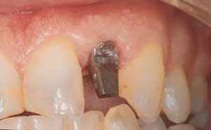 implant-before