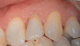 implant-after