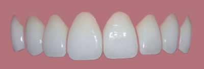 Dental Veneers